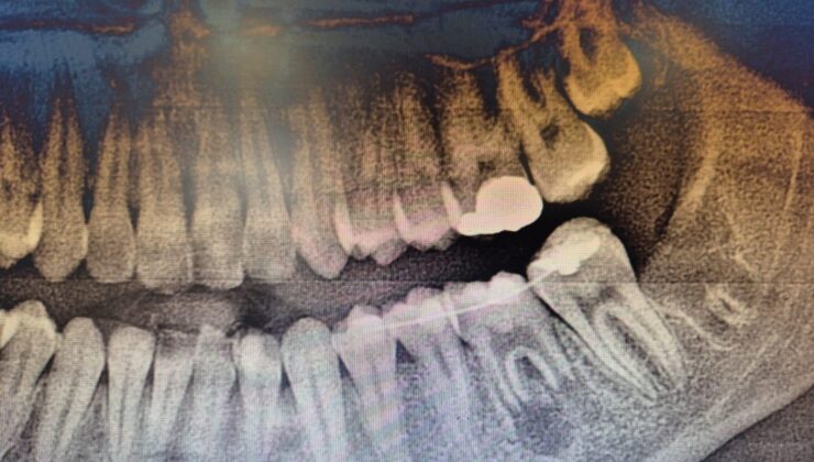 ÇOCUK HASTAYA DİŞ NAKLİ İLE DOĞAL BİR TEDAVİ UYGULANDI